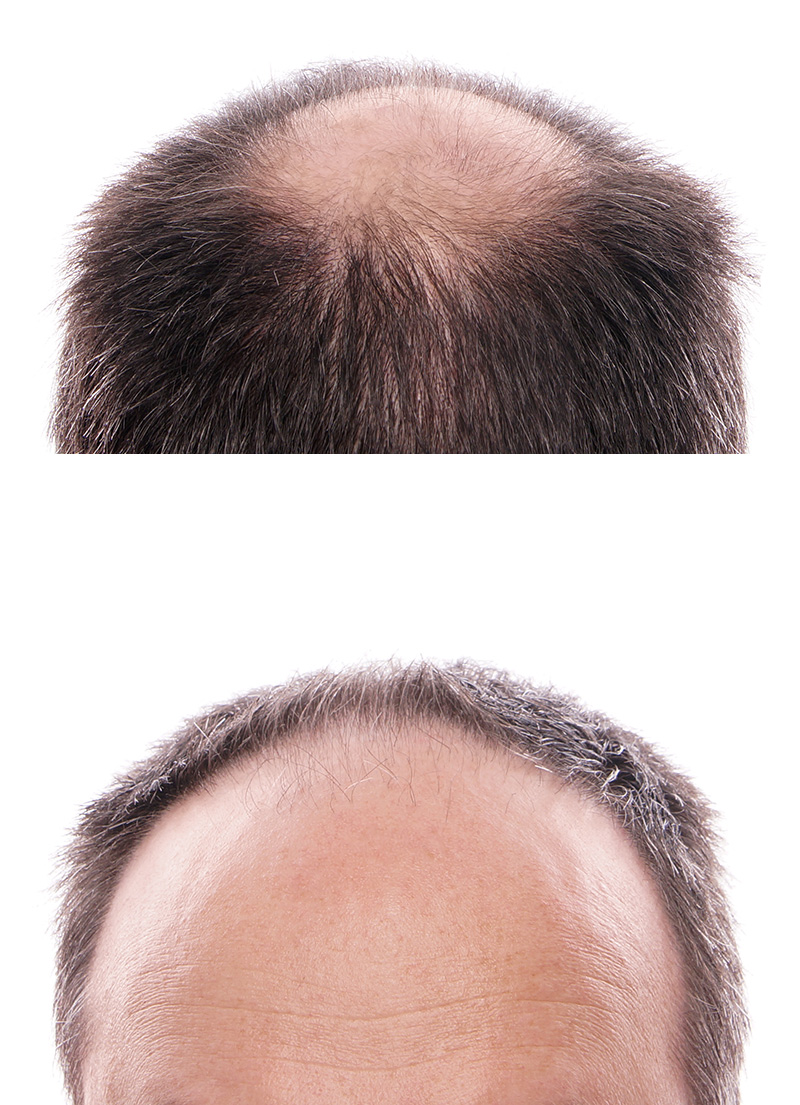 circular hair loss at the back of the head and receding hairline at the front